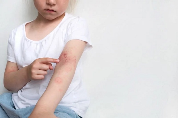 درماتیت آتوپیک یا اگزمای آتوپیک در کودکان بسیار شایع است.  عکس اگزمای آتوپیک