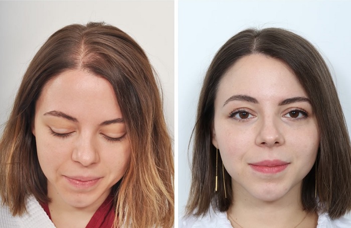 قبل و بعد از کاشت مو در زنان